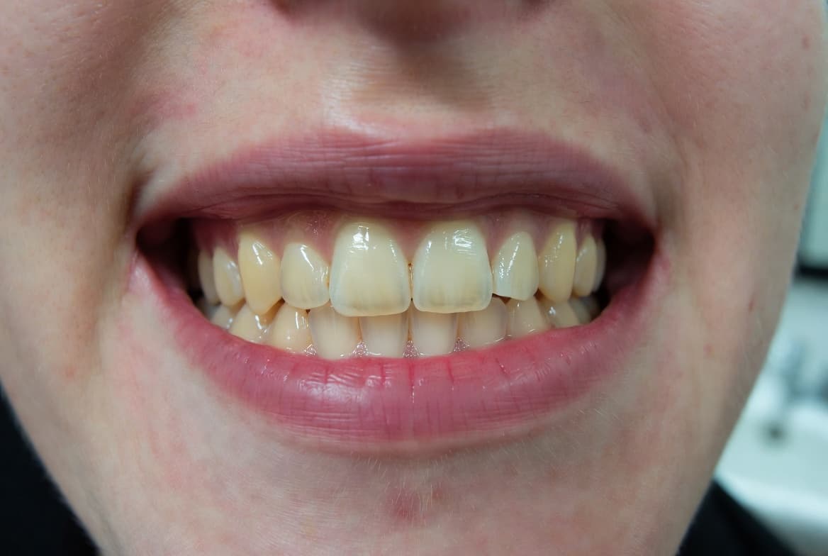 Veneer Case