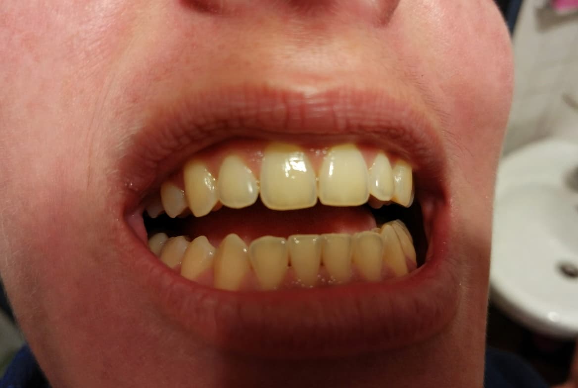 Veneer Case